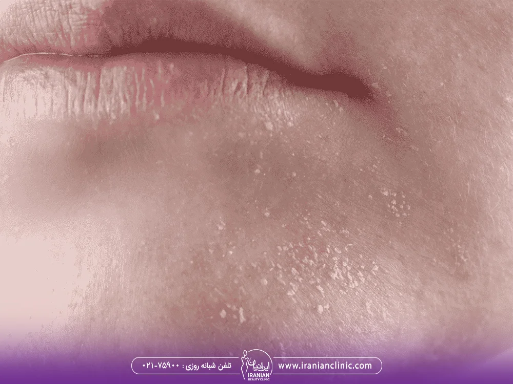 عکس پوست خشک