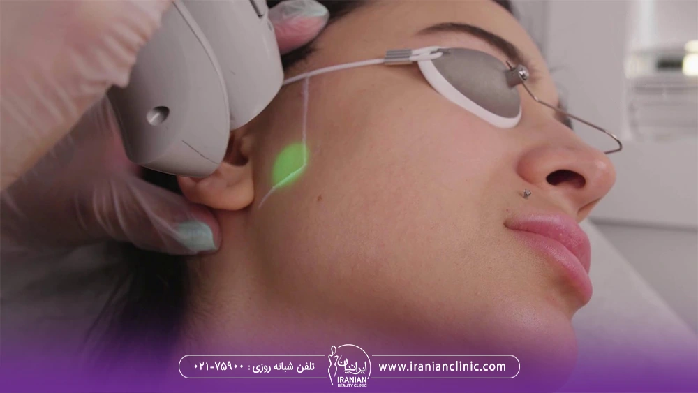 سری لیزر که نزدیک صورت زن جوان گرفته شده و موهای زائد خط ریش او را از بین می برد