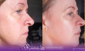 عکس قبل و بعد مزونیدلینگ