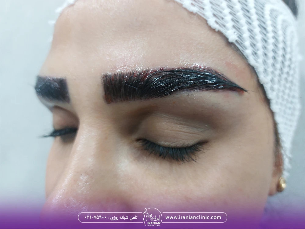 نتیجه کاشت ابروی زن جوان به روش sut
