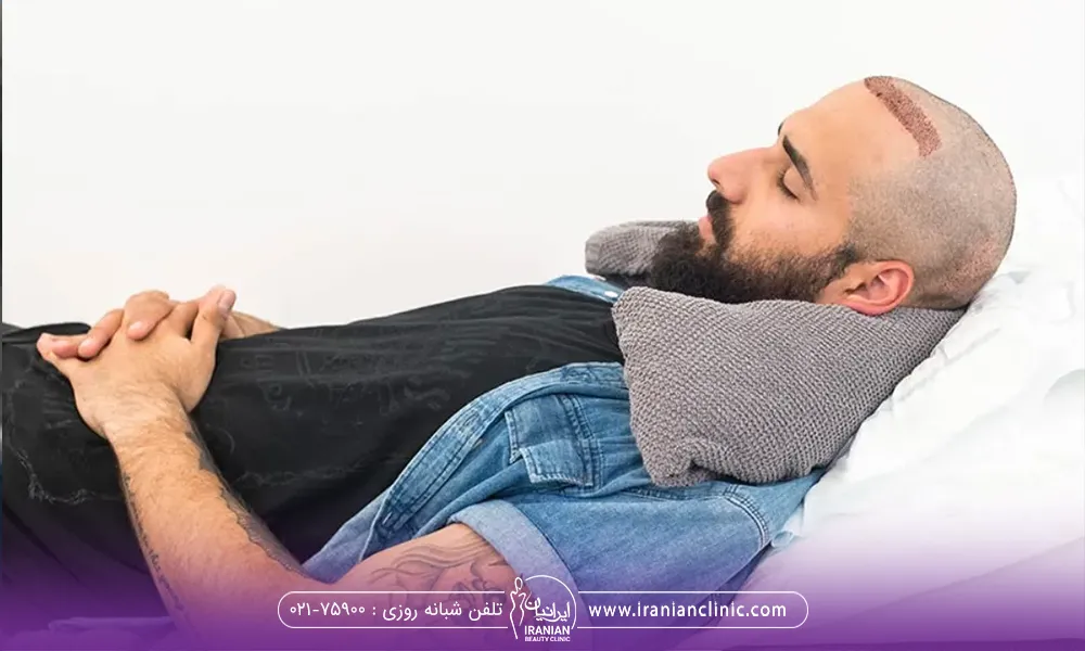 اقایی که بعد از انجام کاشت مو به صورت اصولی دراز کشیده است