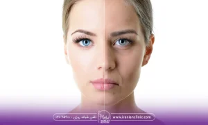 قبل و بعد از یک خانم بعد از پروفایلو برای جوانسازی پوست