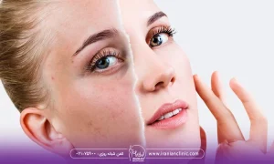 تصویر مربوط به یک خانم است که چشمهای رنگی و موهای قهوه ای روشن دارد و قبل و بعد سابسیژن توی عکس با یک خط فرضی مشخص شده است.