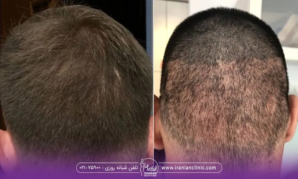 قبل و بعد سر مردی که کاشت مو انجام داده است