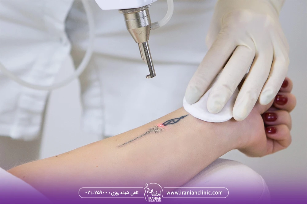 اپراتور لیزر که تاتوی ساعد دختر را پاک می کند