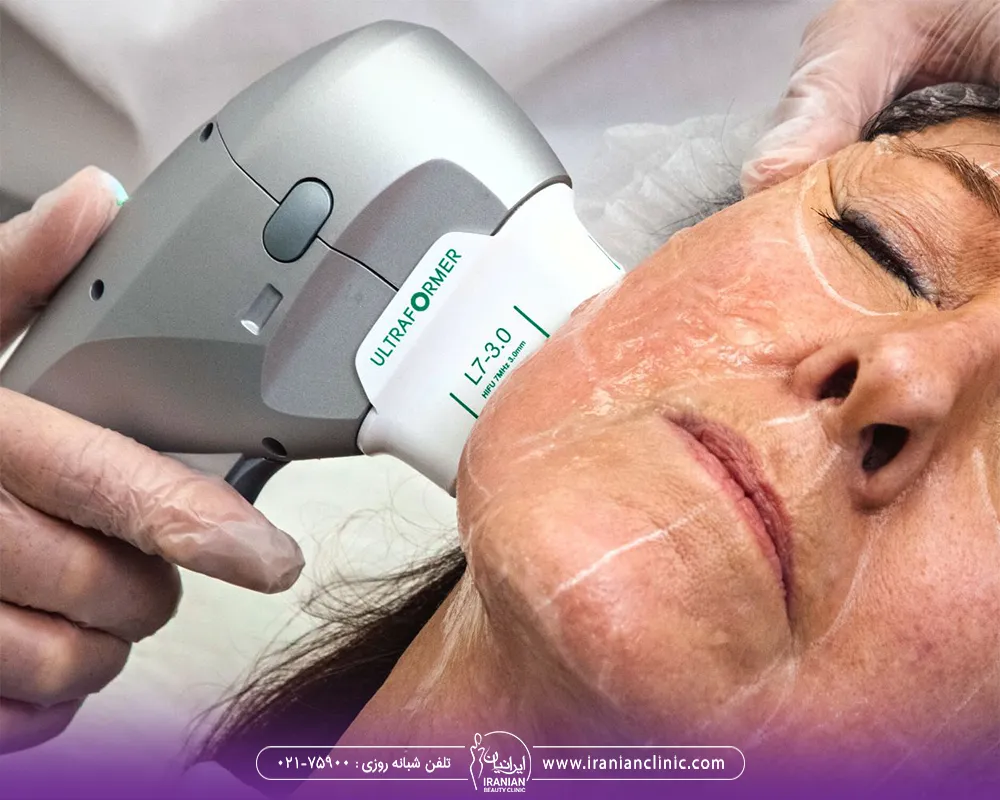 پزشکی که هندپیس دستگاه هایفو را روی صورت زن قرار داده است