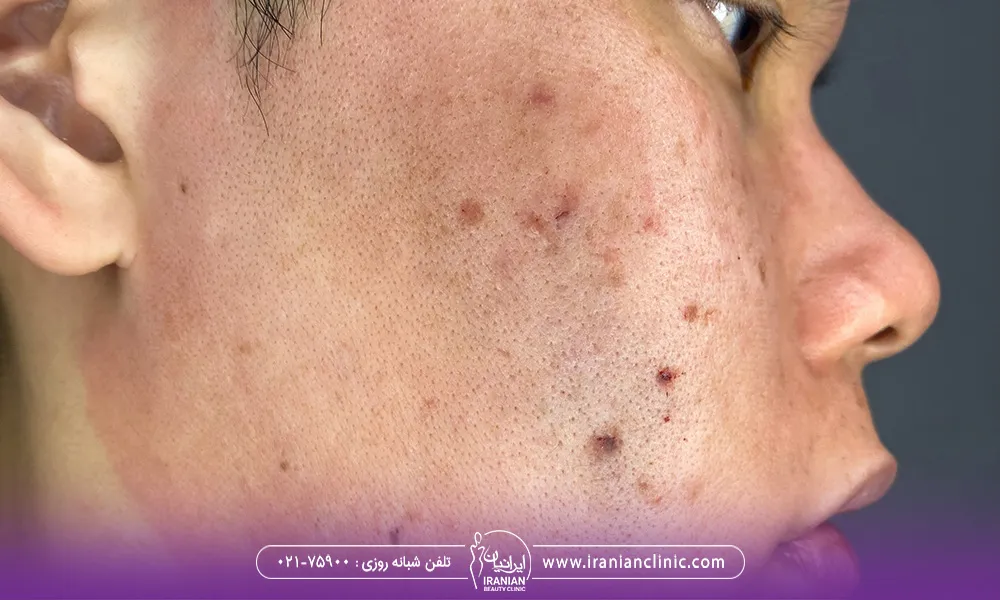 تصویر مربوط به نیمه صورت یک آقا است که بعد از عمل سابسیژن، پوست صورتش ملتهب و قرمز شده است.