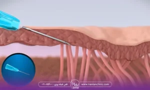 تصویر انیمیشنی قسمتی از پوست است که لایه های زیرین آن مشخص شده و سوزنی که برای انجام سابسیژن در آن قسمت پوست فرو رفته است - عوارض سابسیژن