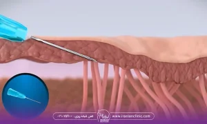 تصویر انیمیشنی قسمتی از پوست است که لایه های زیرین آن مشخص شده و سوزنی که برای انجام سابسیژن در آن قسمت پوست فرو رفته است - عوارض سابسیژن