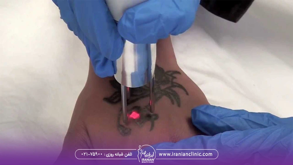 اپراتور لیزر کیوسوئیچ که تتوی روی دست را پاک می کند