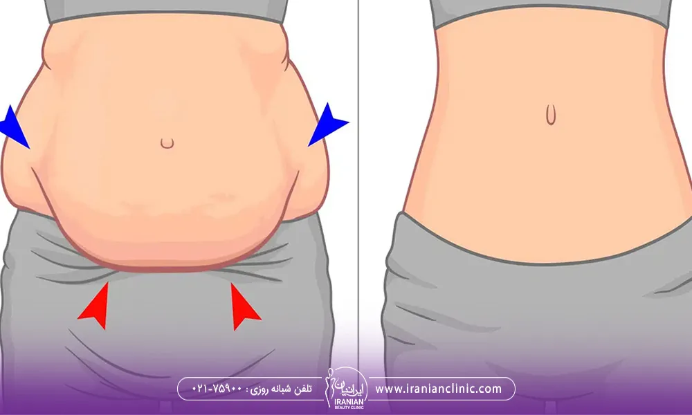 عکس قبل و بعد از شکم آقا یا خانم هست که اشاره به چربی های شکم می کند.