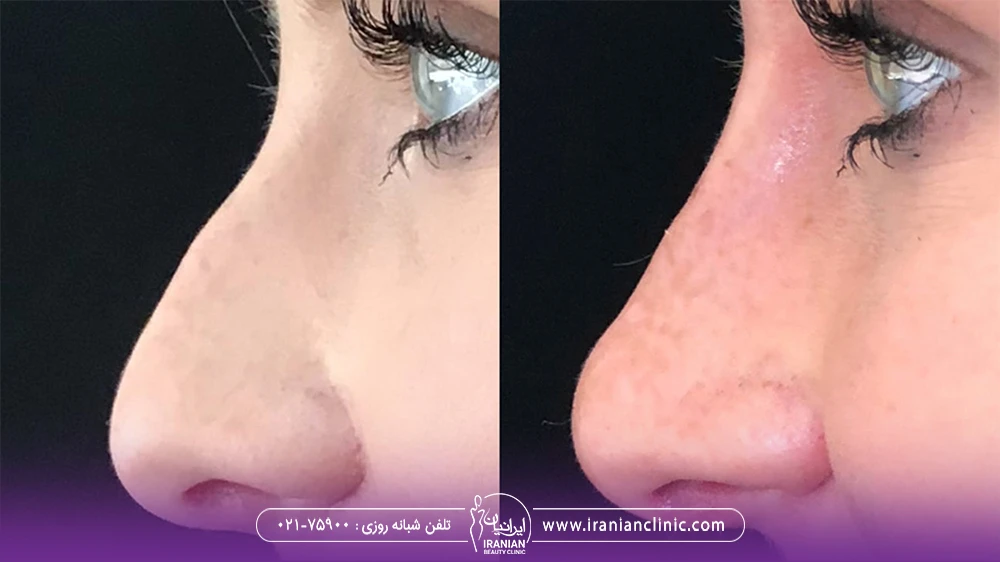 تصویر نزدیک از نتایج قبل و بعد تزریق فیلر به بینی دختر