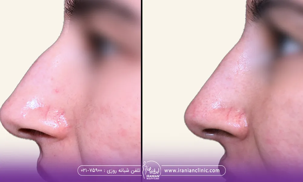 قبل و بعد تزریق فیلر بینی گوشتی