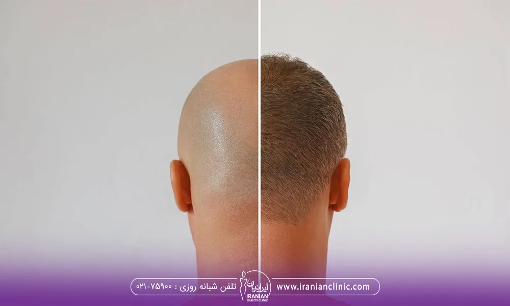 قبل و بعد کاشت ترکیبی روی سر یک آقا