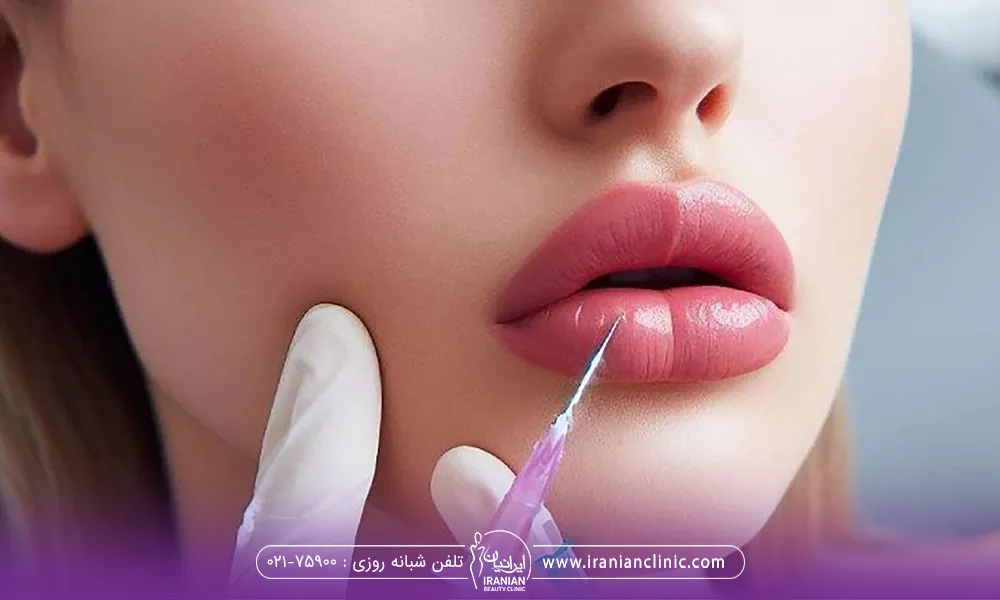 خانمی که توسط پزشک زیبایی در حال انجام تزریق ژل لب است