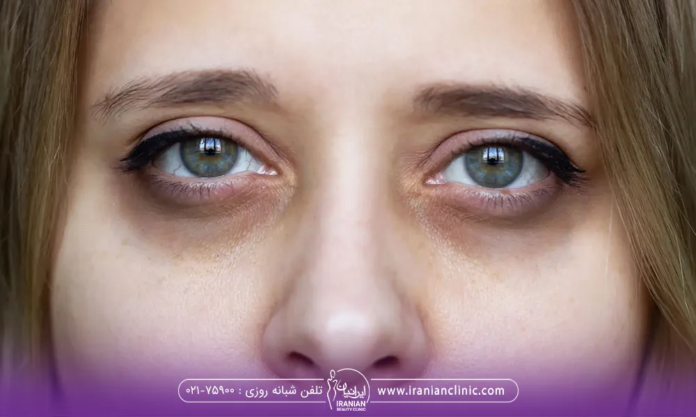 رفع تیرگی زیر چشم با درمان های خانگی