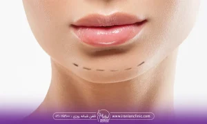 پزشکی که برای یک خانم برای انجام زاوایه سازی فک روی صورت خانم علامت گذاری کرده است