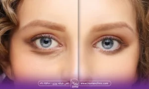 خانمی که اقدام به رفع تیرگی چشم هایش کرده و در قبل و بعد مشخص است