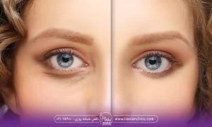 خانمی که اقدام به رفع تیرگی چشم هایش کرده و در قبل و بعد مشخص است