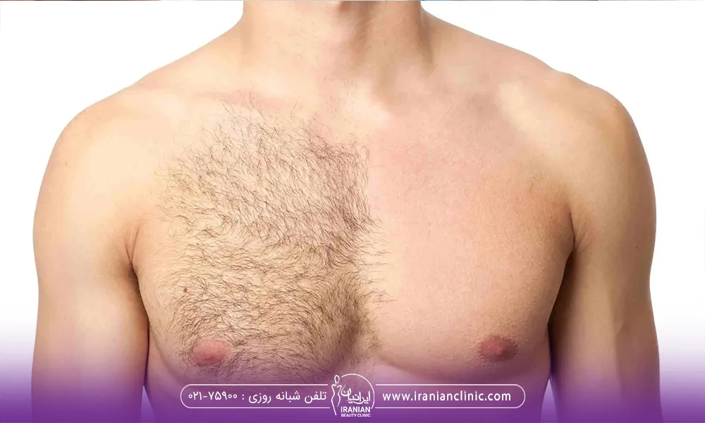 قبل و بعد قفسه سینه یک مرد که لیزر انجام داده 