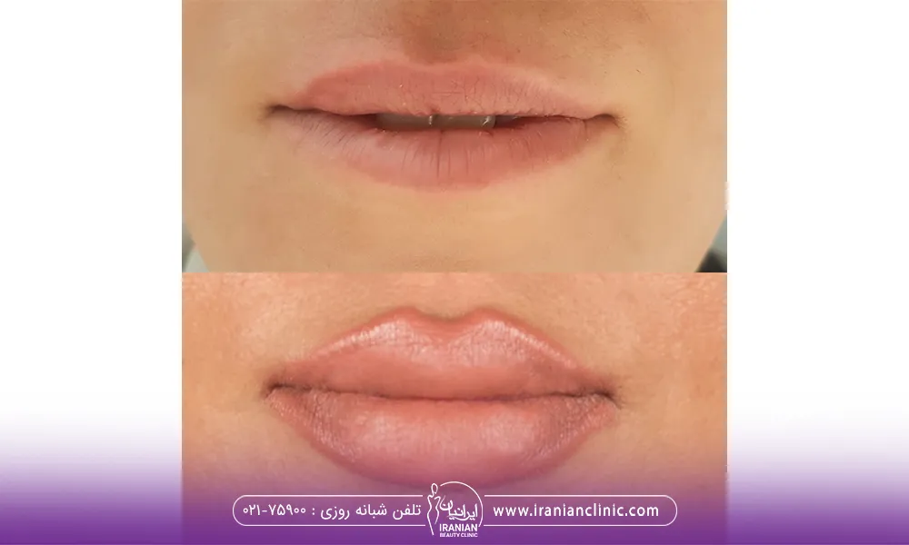 قبل و بعد تزریق ژل لب