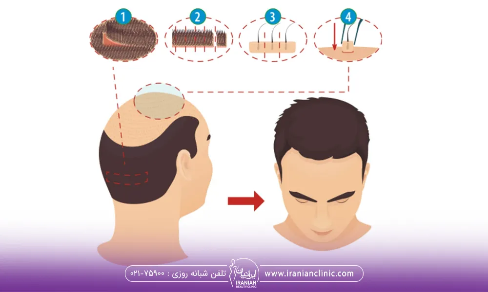 کاشت مو به روش fut