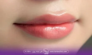 فردی که بعد از تزریق ژل لبهایش رضایت دارد