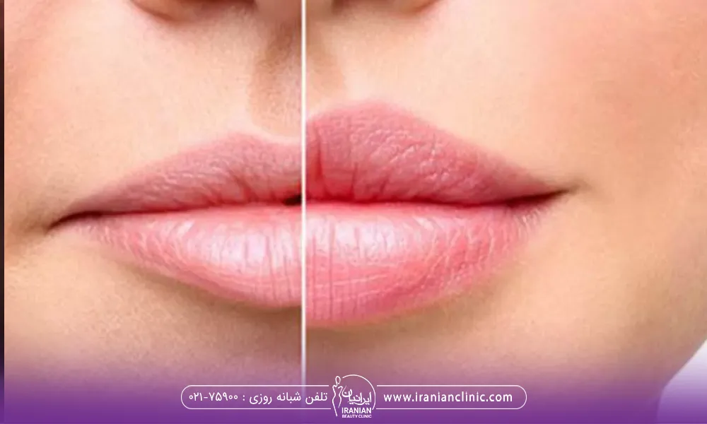 قبل و بعد یک خانم بعد از طزریق ژل لب