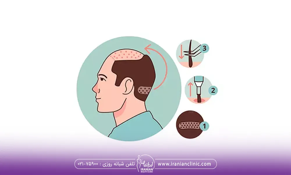 کاشت مو به روش FIT