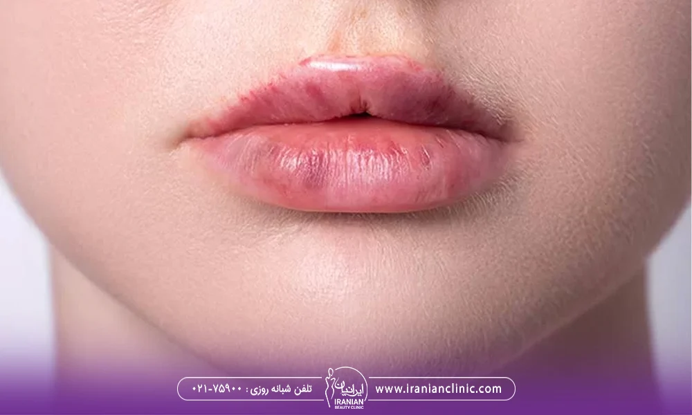 کبودی لب بعد از تزریق ژل - خانم جوانی که بعد از تزریق ژل لب دچار کبودی و تورم لب شده است