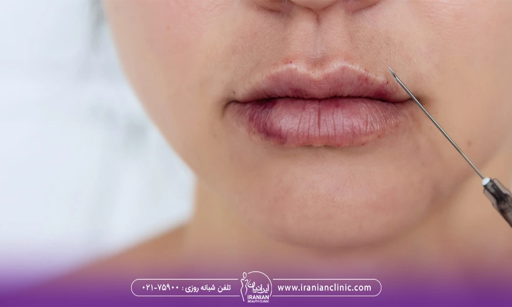 نکروز لب بهد از تزریق ژل که برای خانم جوانی ایجاد درد و التهاب کرده ست