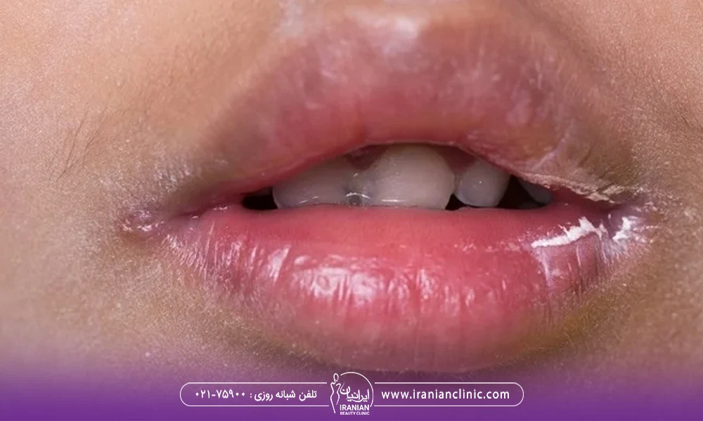 تورم و التهاب از علائم نکروز لب که برای این خانم جوان رخ داده است