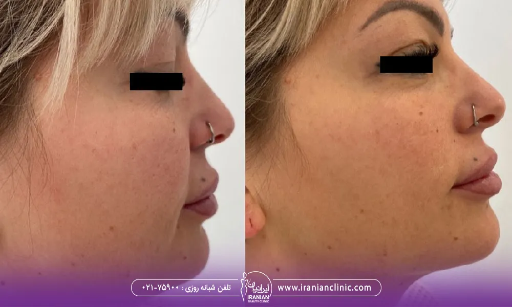 عکس قبل و بعد هایفوتراپی