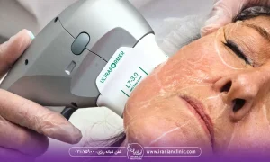 زنی که پزشک سمت راست صورت او را هایفو می کند - بهترین کلینیک هایفو