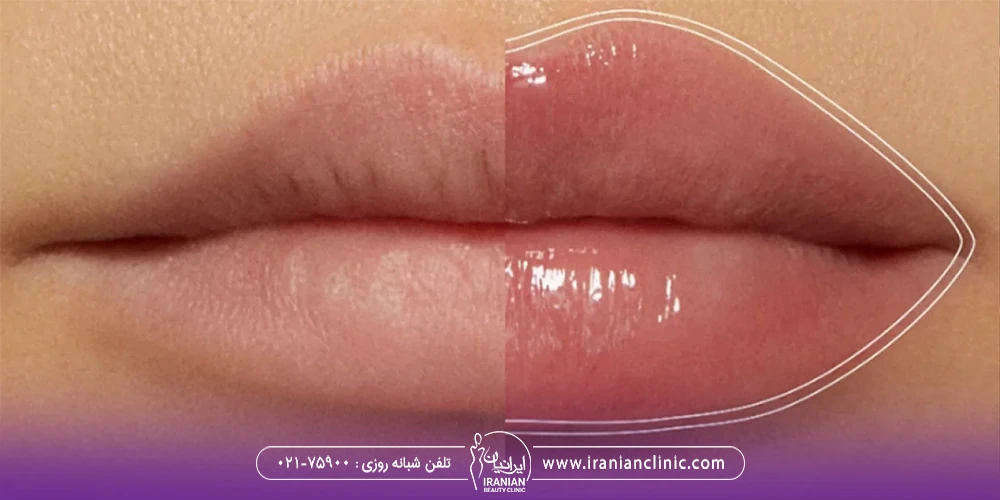 عکس قبل و بعد تزریق ژل لب صدفی