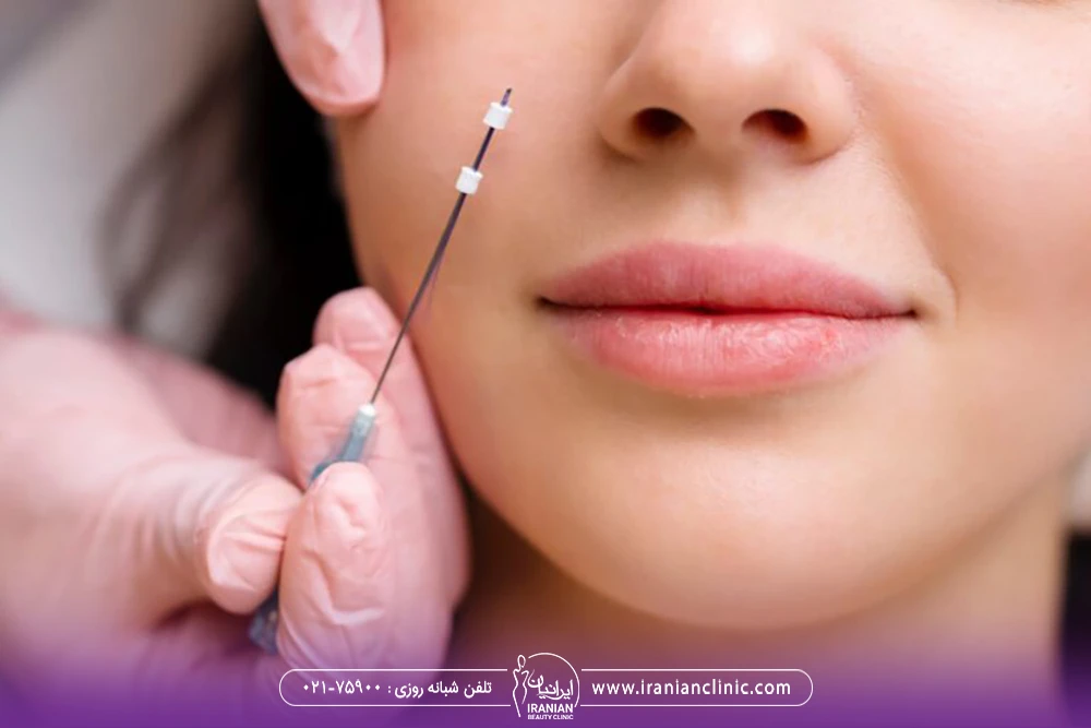 صورت زن که پزشک یک نخ لیفت در کنار آن گرفته است