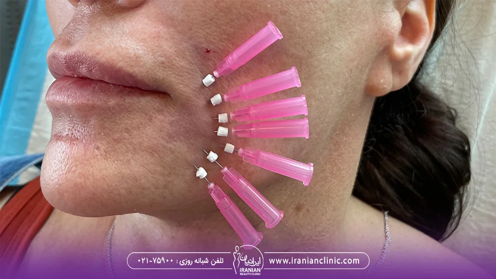 چند نخ لیفت که در کنار دهان و خط لبخند زن قرار داده شده
