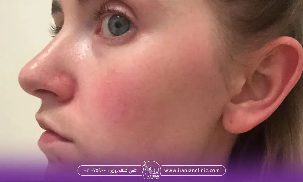 صورت یک خانم با چشمهای قرمز که بعد از انجام اندولیفت قرمز شده - ورم بعد از اندولیفت