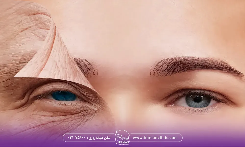 تاثیر اندولیفت بر روی عکس مشاهده می شود. نیمه صورت که یک لایه از پوست پیر و پر چروک از روی آن برداشته شده است