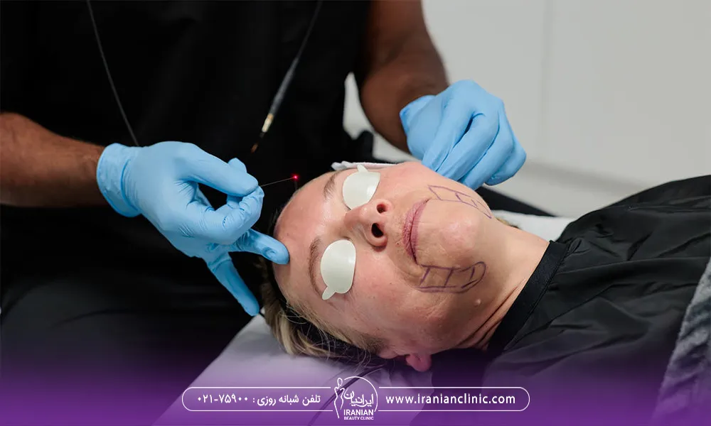 پزشک در حال انجام اندولیفت بر روی صورت یک خانم که چشم هایش با یک چشم بند به دلیل لیزر اندولیفت بسته شده که از آنها محافظت شود.