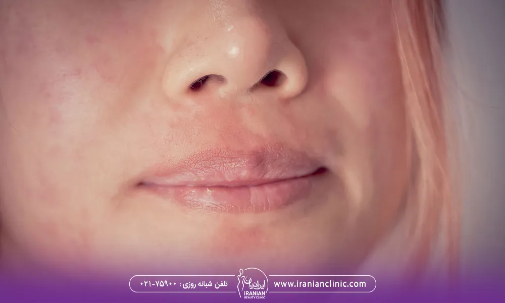 نیمه صورت یک خانم است که بعد از اندولیفت ملتهب شده