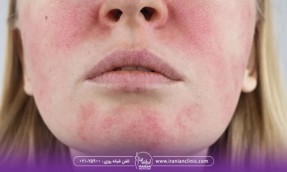 تصویر نیمه صورت یک خانم است که بعد از اندولیفت دچار قرمزی و التهاب شده