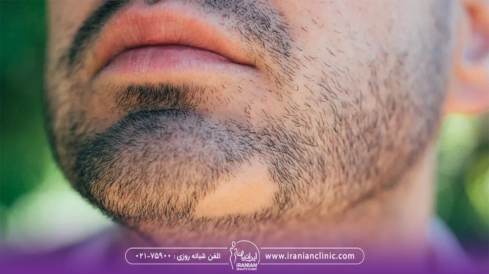 مردی که دچار ریزش ریش خود شده است