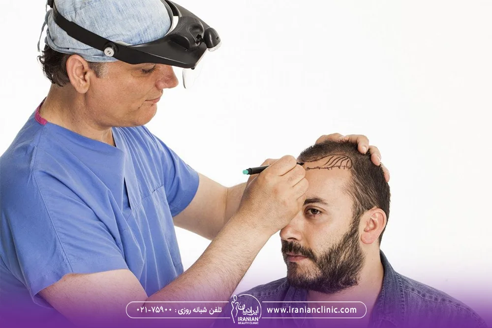 دکتری که پیش از کاشت روی خط رویش مرد طراحی می کند - دوران نقاهت کاشت مو