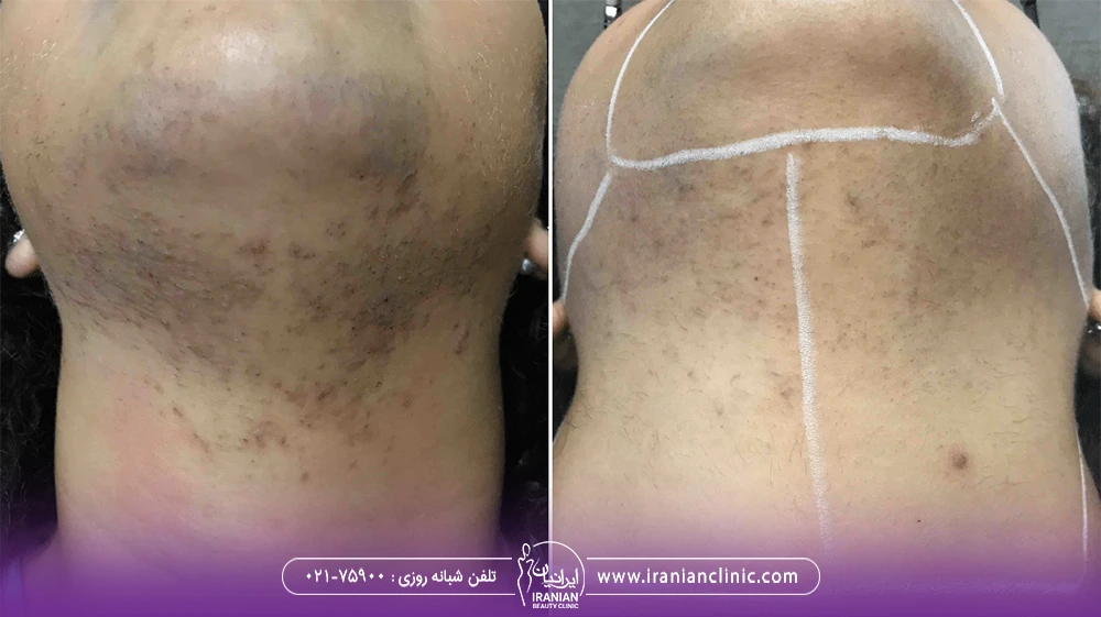 عکس قبل و بعد لیزر چانه زن