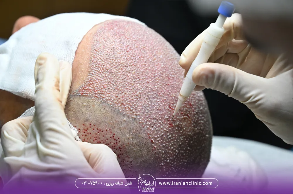 پزشک در حال انجام کاشت مو dhi روی سر مرد