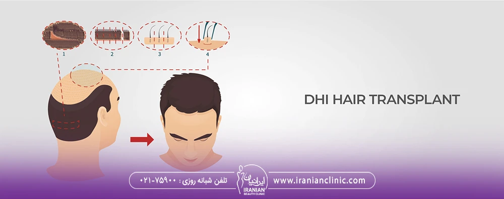 تصویر از نحوه کاشت مو به روش DHI
