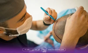 پزشکی که به روی سر مرد کاشت مو انجام می دهد - روش کاشت مو hrt