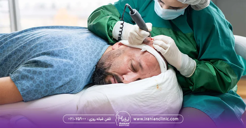 پزشک در حال پیوند فولیکول های مو به سر مرد