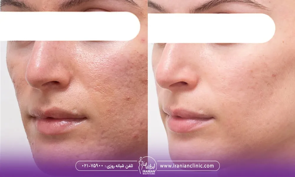 قبل و بعد صورت یک آقا که با انجام اندولیفت جای جوش هایش از بین رفته